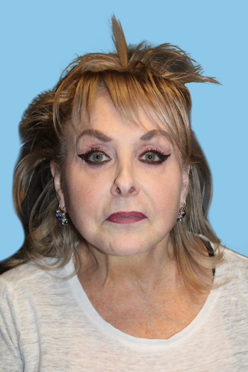Facelift & Necklift Before & After Gallery - Patient 345139 - Image 2