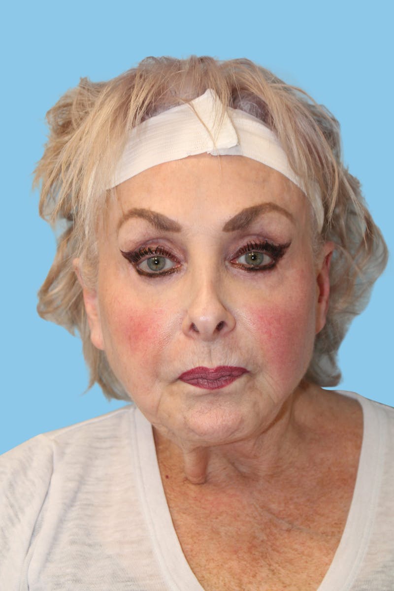 Facelift & Necklift Before & After Gallery - Patient 345139 - Image 1