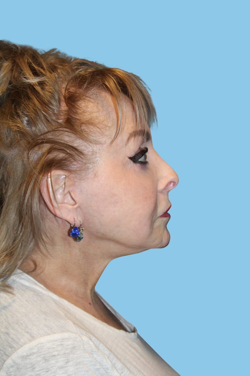 Facelift & Necklift Before & After Gallery - Patient 345139 - Image 4