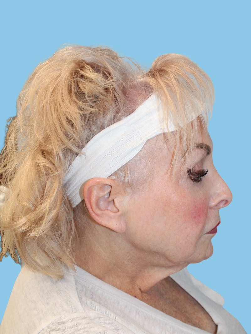 Facelift & Necklift Before & After Gallery - Patient 345139 - Image 3