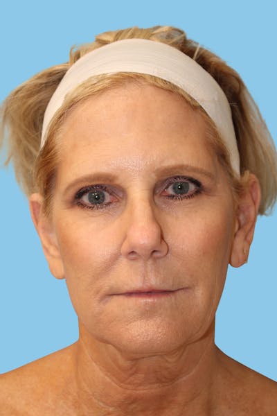 Facelift & Necklift Before & After Gallery - Patient 291318 - Image 1