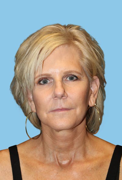 Facelift & Necklift Before & After Gallery - Patient 291318 - Image 2