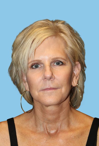 SWIFT LIFT ® / Facelift / Necklift  Before & After Gallery - Patient 291318 - Image 2