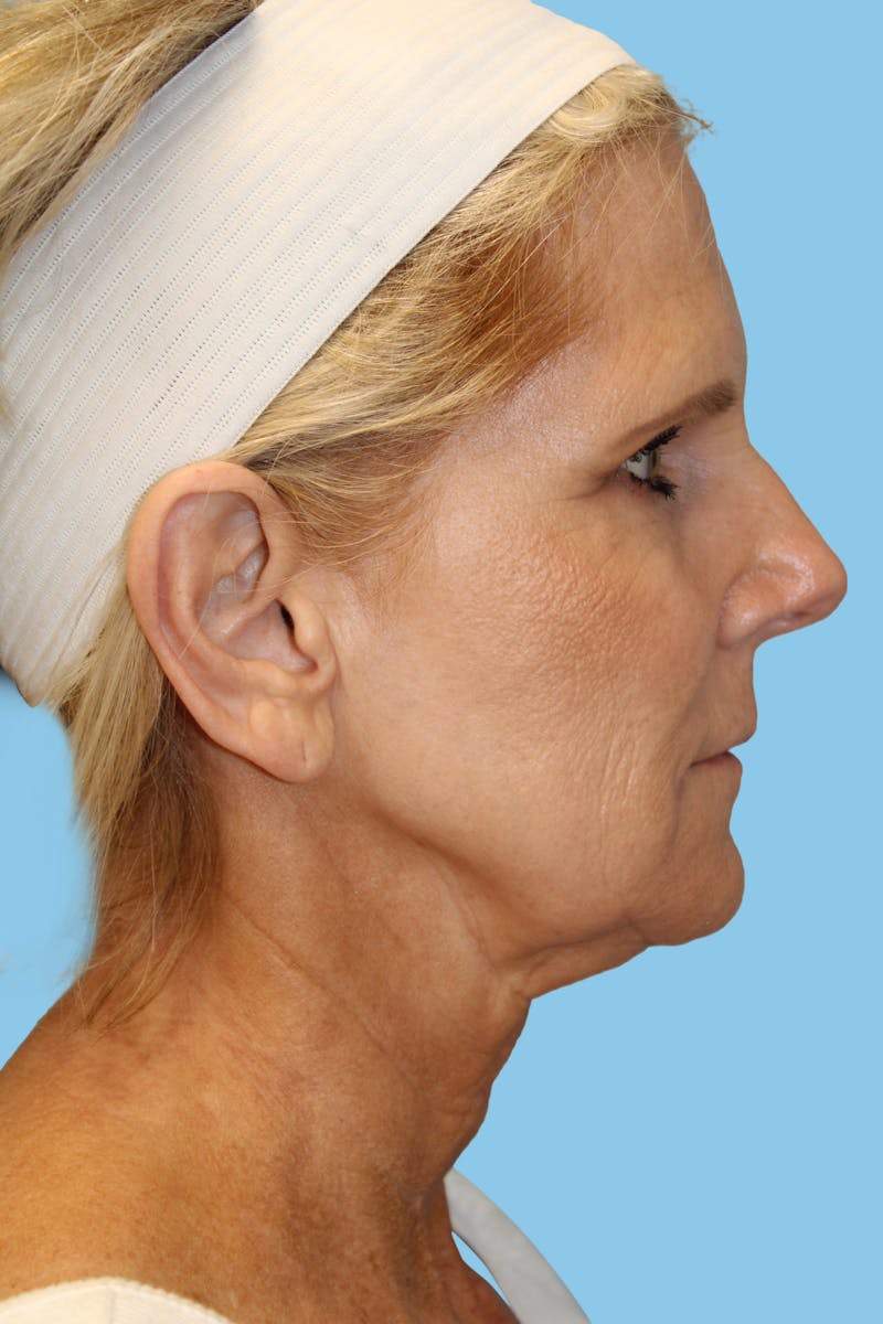 Facelift & Necklift Before & After Gallery - Patient 291318 - Image 3