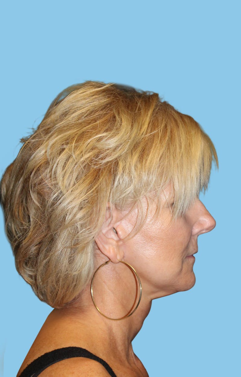 Facelift & Necklift Before & After Gallery - Patient 291318 - Image 4
