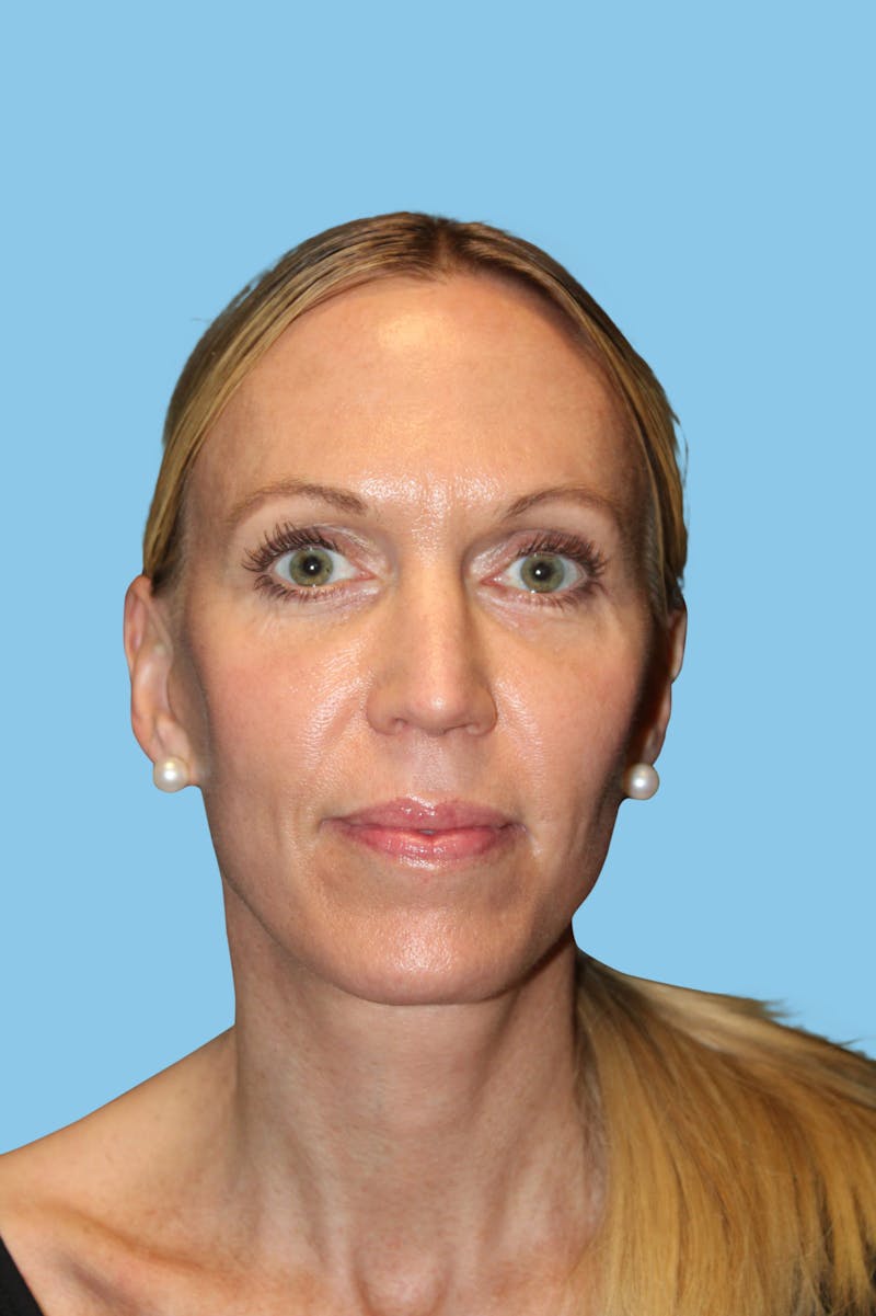 Facelift & Necklift Before & After Gallery - Patient 291995 - Image 2