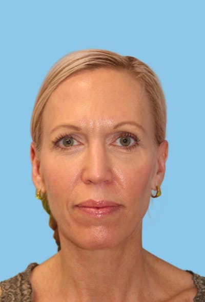 SWIFT LIFT ® / Facelift / Necklift  Before & After Gallery - Patient 291995 - Image 1
