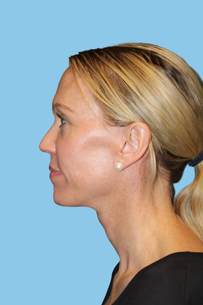 Facelift & Necklift Before & After Gallery - Patient 291995 - Image 3