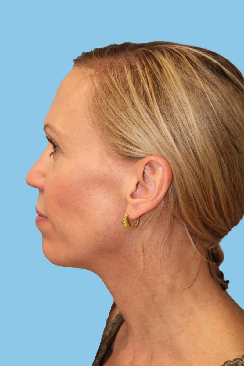 Facelift & Necklift Before & After Gallery - Patient 291995 - Image 4