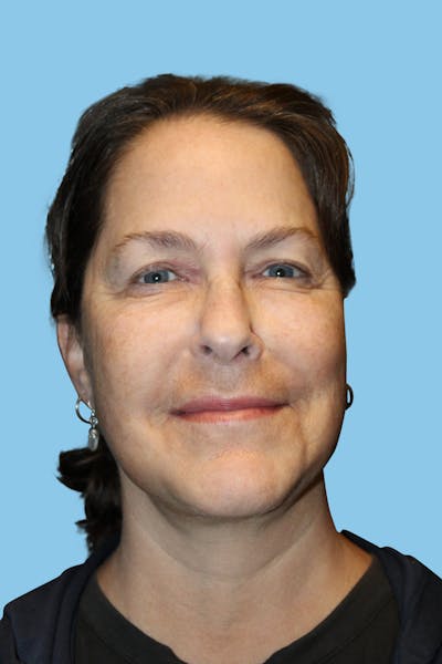 SWIFT LIFT ® / Facelift / Necklift  Before & After Gallery - Patient 180557 - Image 2