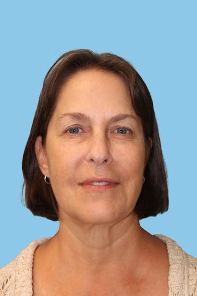 Facelift & Necklift Before & After Gallery - Patient 180557 - Image 1