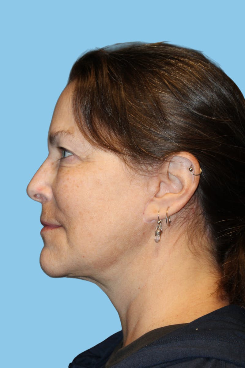 Facelift & Necklift Before & After Gallery - Patient 180557 - Image 4