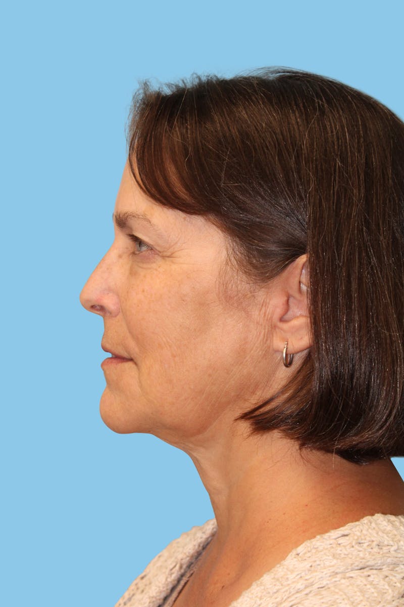 Facelift & Necklift Before & After Gallery - Patient 180557 - Image 3
