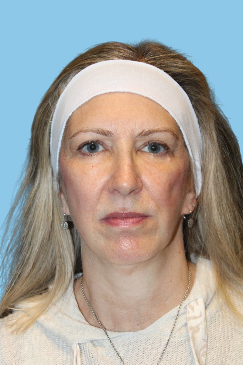 Facelift & Necklift Before & After Gallery - Patient 428698 - Image 2