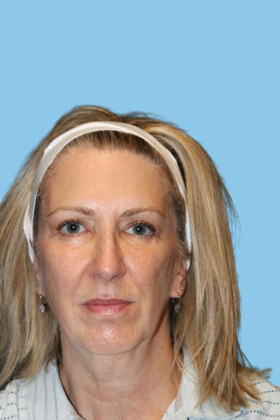 SWIFT LIFT ® / Facelift / Necklift  Before & After Gallery - Patient 428698 - Image 1