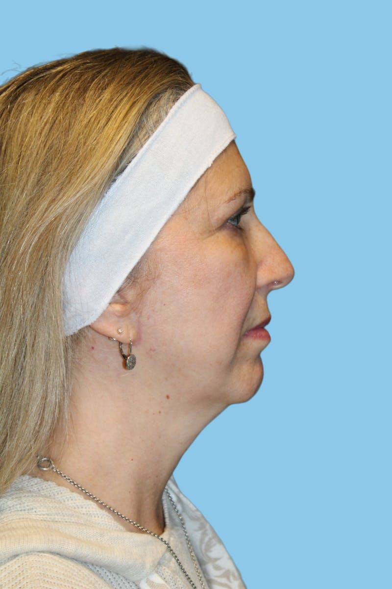Facelift & Necklift Before & After Gallery - Patient 428698 - Image 4