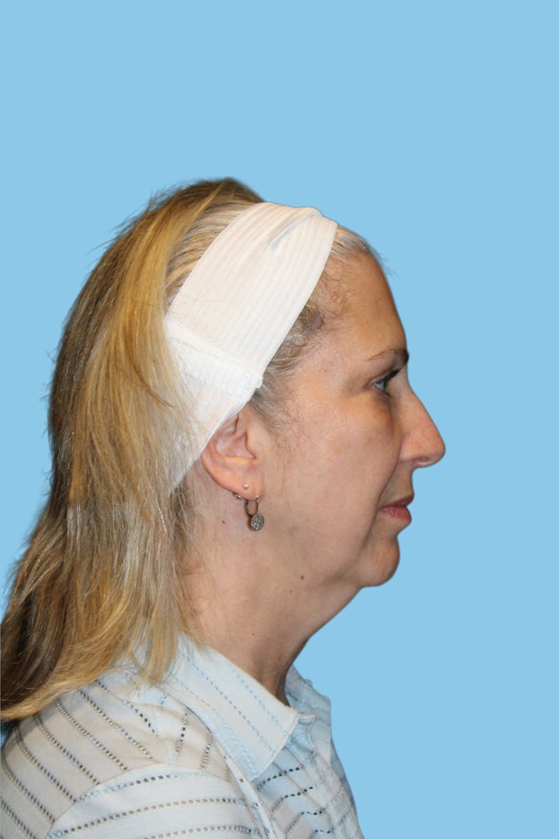 Facelift & Necklift Before & After Gallery - Patient 428698 - Image 3