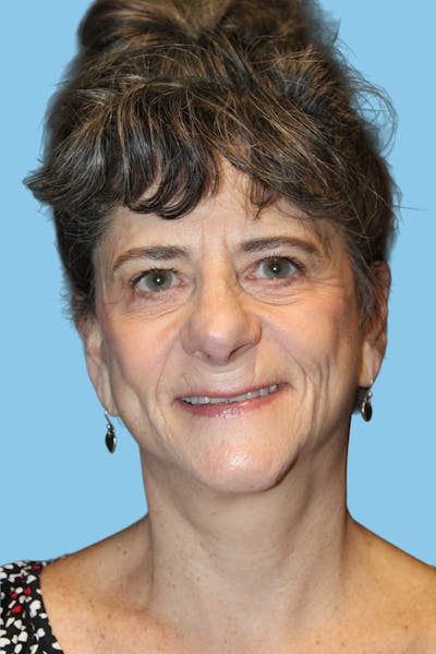 SWIFT LIFT ® / Facelift / Necklift  Before & After Gallery - Patient 422620 - Image 2
