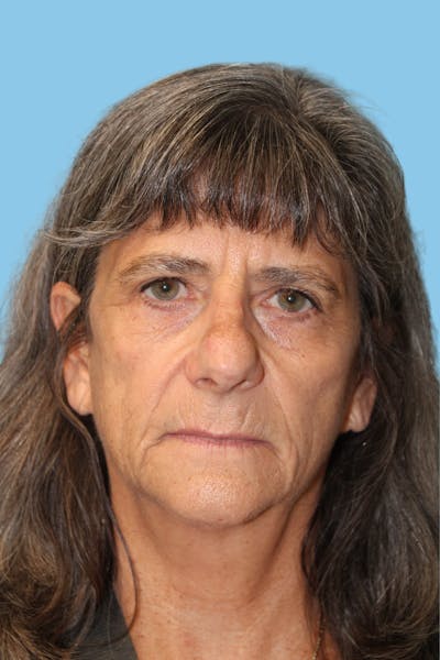 SWIFT LIFT ® / Facelift / Necklift  Before & After Gallery - Patient 422620 - Image 1