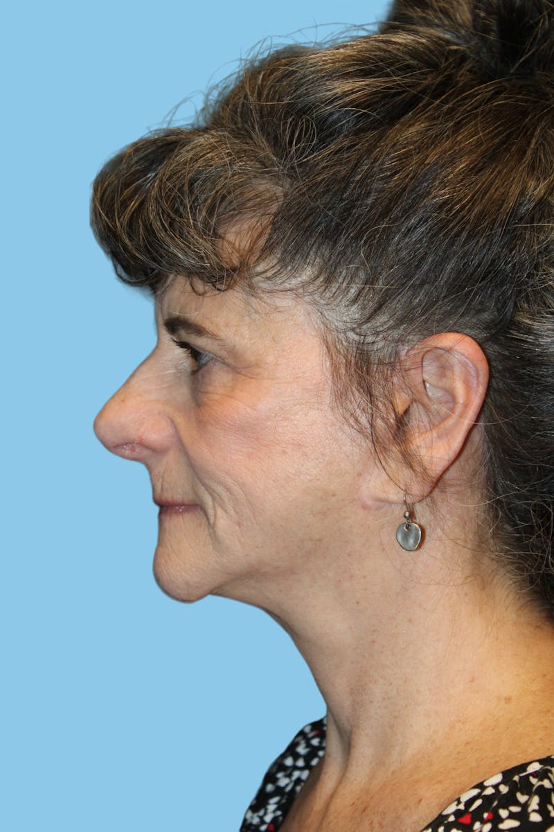 Facelift & Necklift Before & After Gallery - Patient 422620 - Image 4