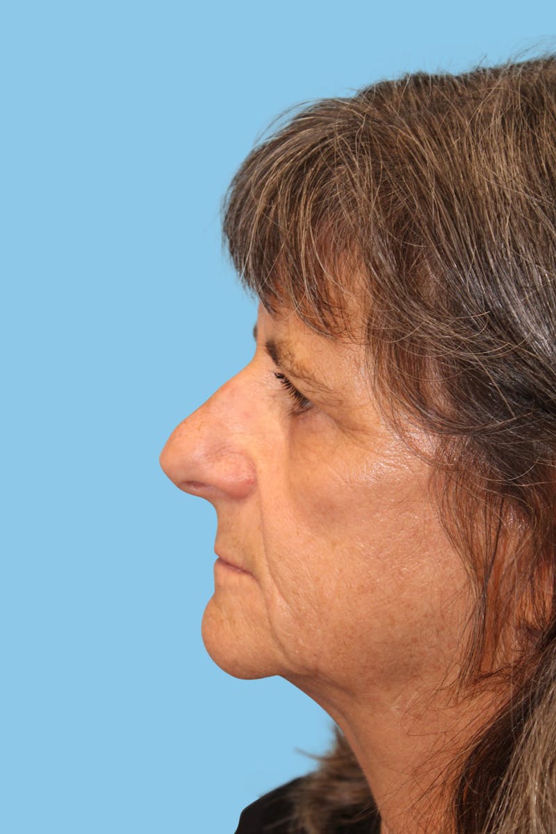 Facelift & Necklift Before & After Gallery - Patient 422620 - Image 3
