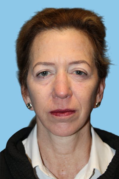Facelift & Necklift Before & After Gallery - Patient 322466 - Image 2