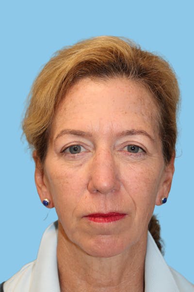 SWIFT LIFT ® / Facelift / Necklift  Before & After Gallery - Patient 322466 - Image 1