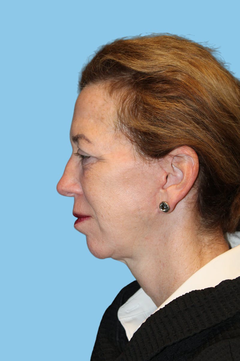 Facelift & Necklift Before & After Gallery - Patient 322466 - Image 4