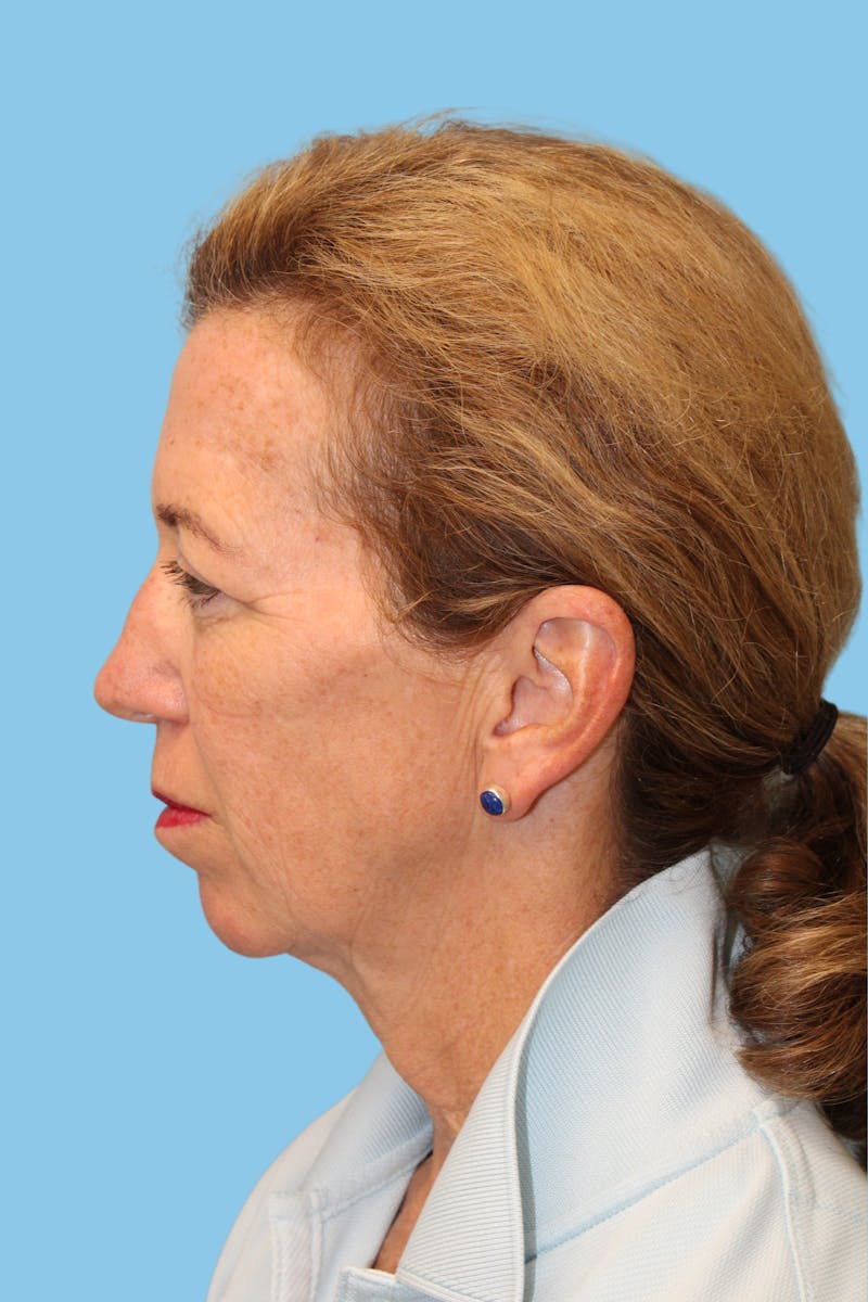 Facelift & Necklift Before & After Gallery - Patient 322466 - Image 3