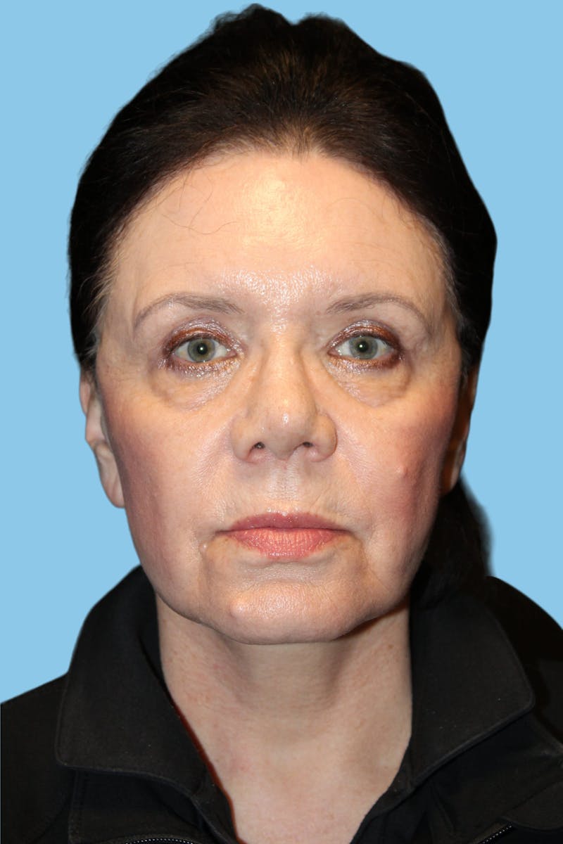 Facelift & Necklift Before & After Gallery - Patient 303518 - Image 2