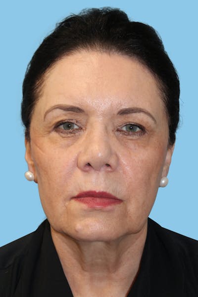 Facelift & Necklift Before & After Gallery - Patient 303518 - Image 1