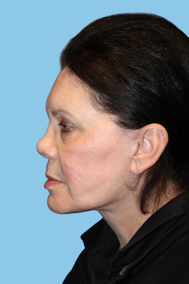 Facelift & Necklift Before & After Gallery - Patient 303518 - Image 3