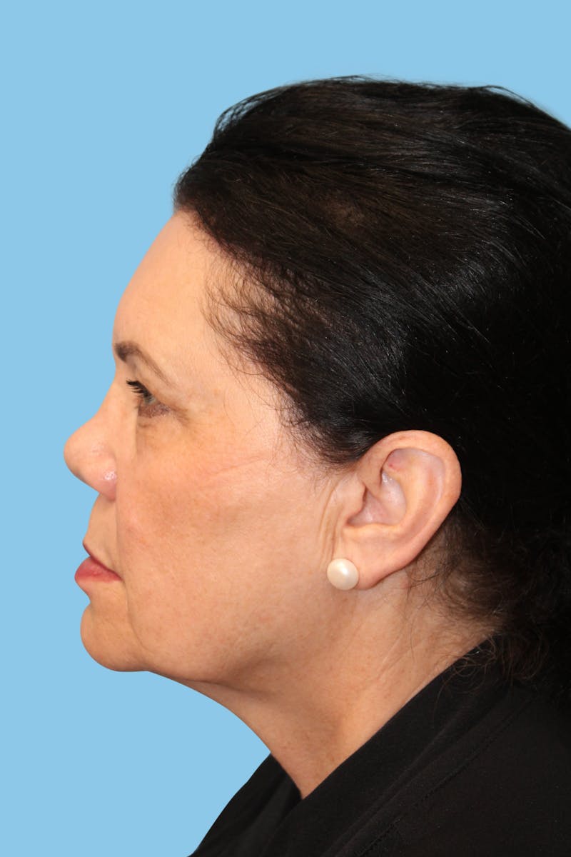 Facelift & Necklift Before & After Gallery - Patient 303518 - Image 4