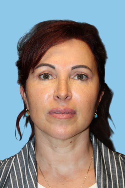 Facelift & Necklift Before & After Gallery - Patient 841072 - Image 2
