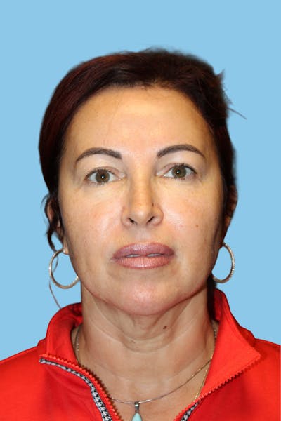 Facelift & Necklift Before & After Gallery - Patient 841072 - Image 1