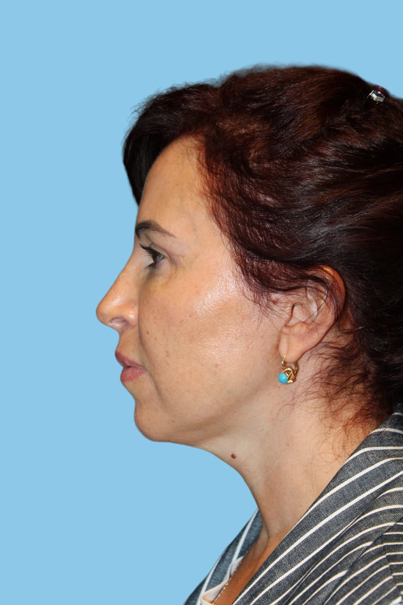 Facelift & Necklift Before & After Gallery - Patient 841072 - Image 4
