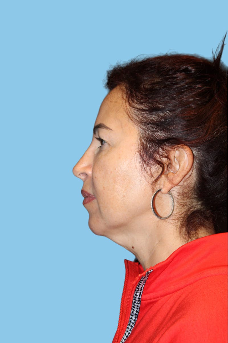 SWIFT LIFT ® / Facelift / Necklift  Before & After Gallery - Patient 841072 - Image 3