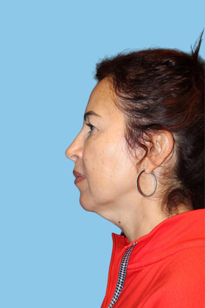 Facelift & Necklift Before & After Gallery - Patient 841072 - Image 3