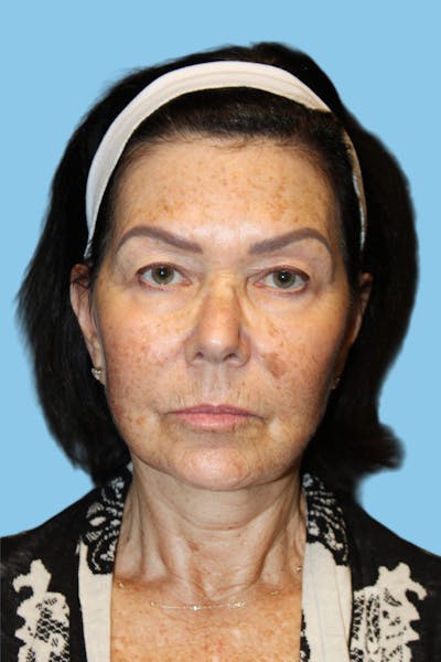 Facelift & Necklift Before & After Gallery - Patient 418546 - Image 2