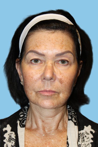 SWIFT LIFT ® / Facelift / Necklift  Before & After Gallery - Patient 418546 - Image 2