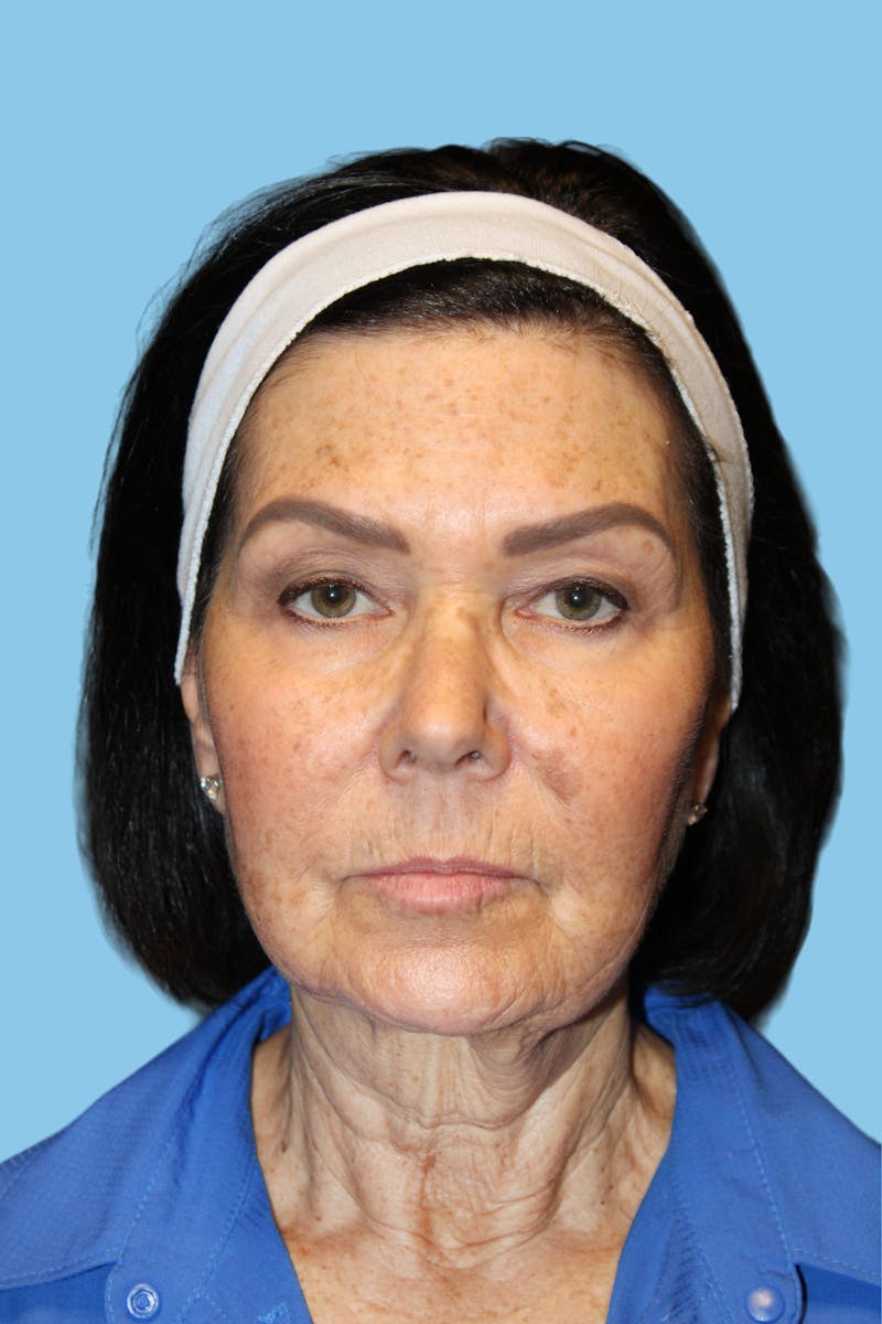 Facelift & Necklift Before & After Gallery - Patient 418546 - Image 1