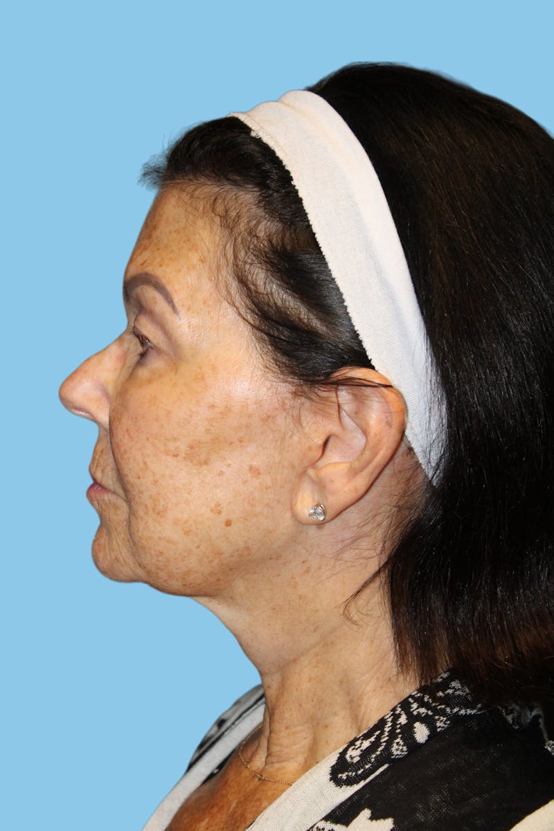 Facelift & Necklift Before & After Gallery - Patient 418546 - Image 4