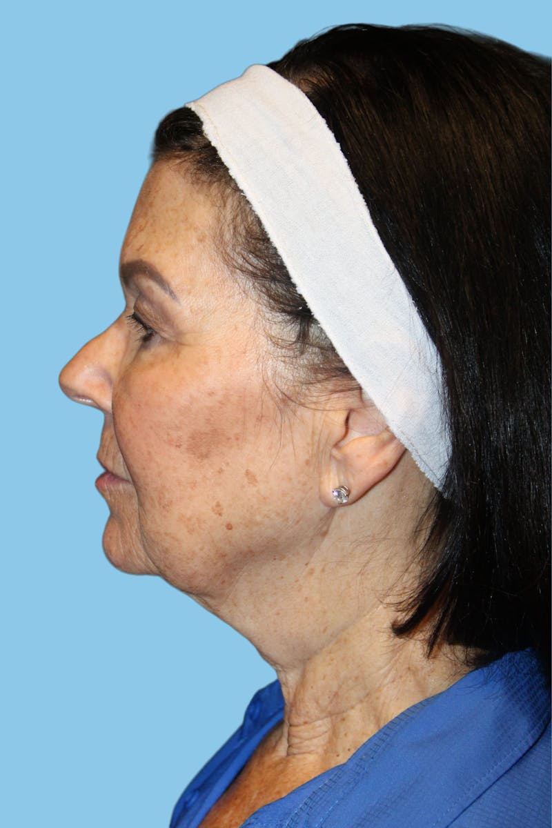 Facelift & Necklift Before & After Gallery - Patient 418546 - Image 3