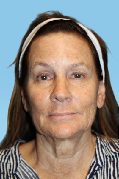 Facelift & Necklift Before & After Gallery - Patient 363847 - Image 2