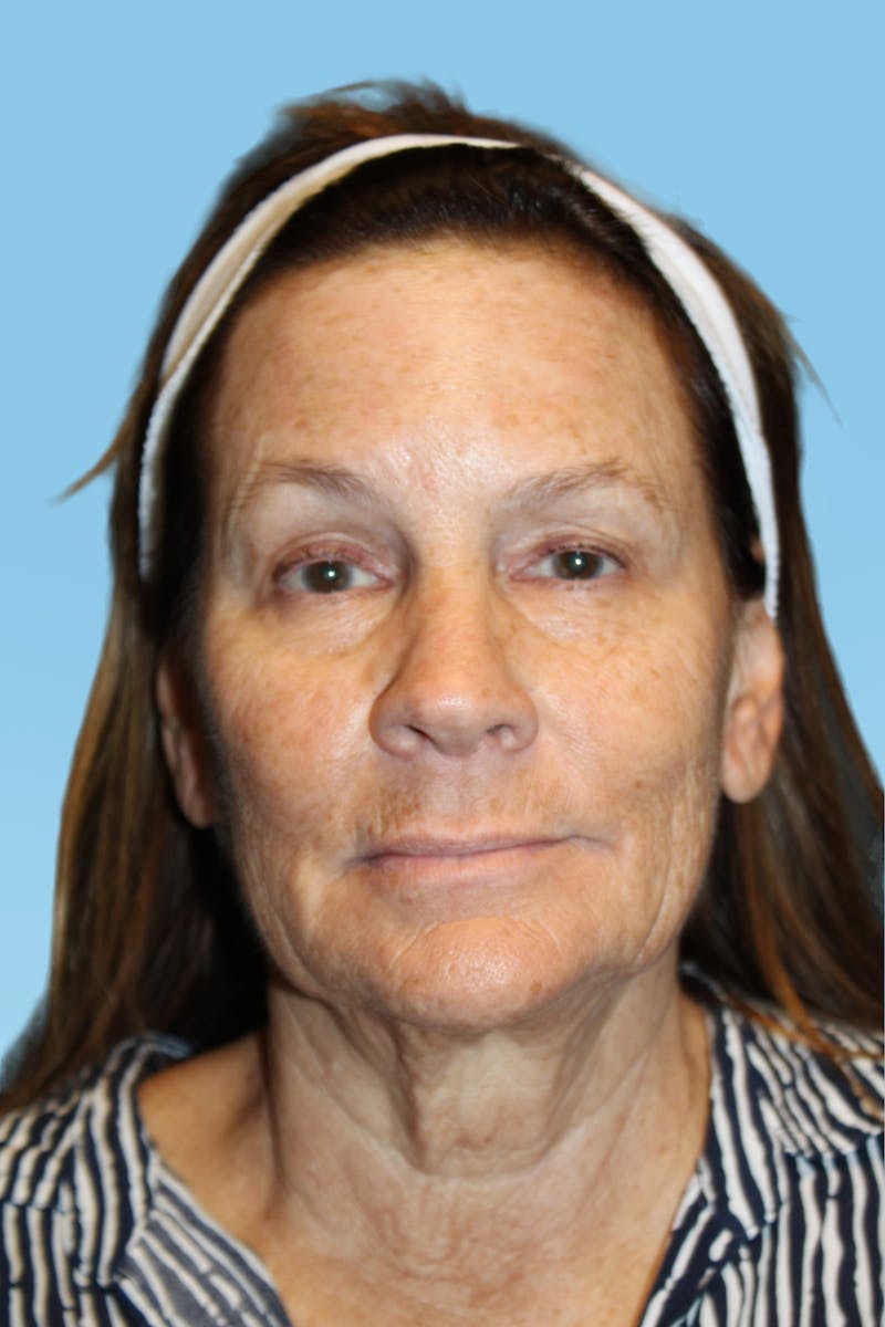 SWIFT LIFT ® / Facelift / Necklift  Before & After Gallery - Patient 363847 - Image 2
