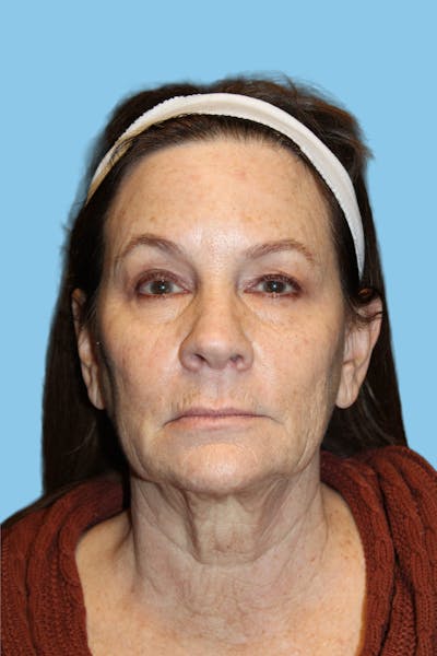 Facelift & Necklift Before & After Gallery - Patient 363847 - Image 1