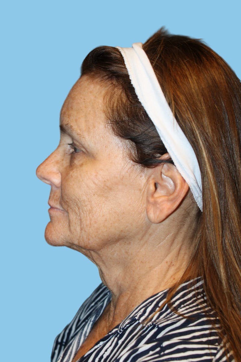 Facelift & Necklift Before & After Gallery - Patient 363847 - Image 4
