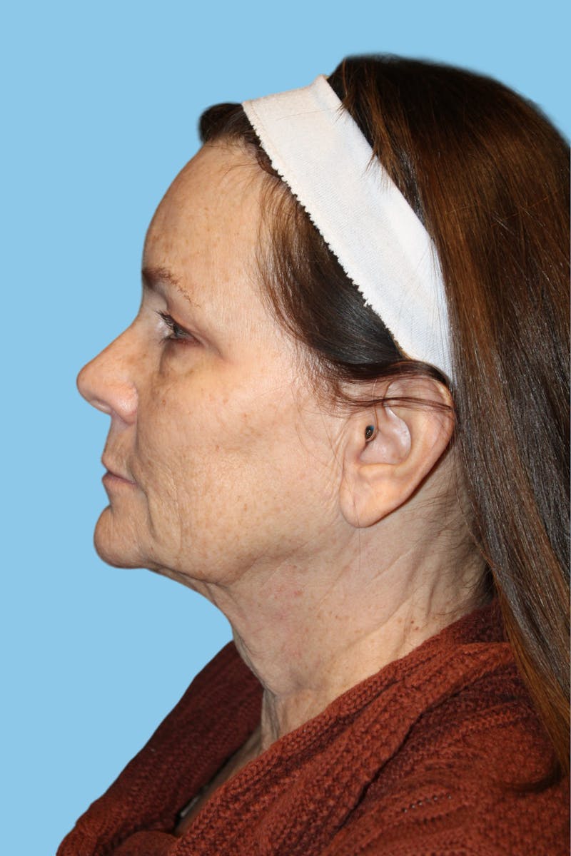 Facelift & Necklift Before & After Gallery - Patient 363847 - Image 3
