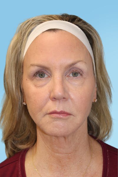 FaceTite Before & After Gallery - Patient 321663 - Image 2