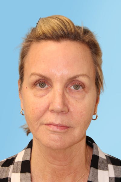 FaceTite Before & After Gallery - Patient 321663 - Image 1